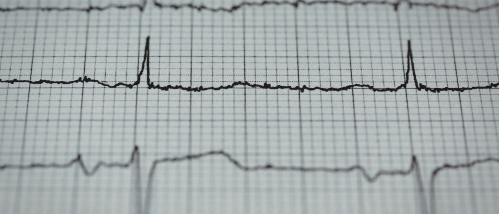 What Are Shockable Rhythms On An AED
